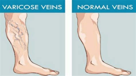 Common Risk Factors For Varicose Veins Youtube