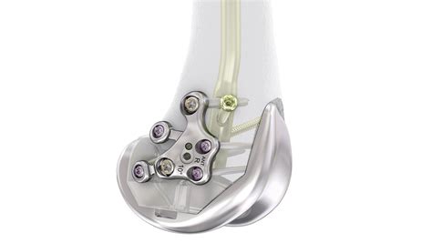 Variable Angle Lcp™ Periprosthetic Proximal Femur Plating System 354