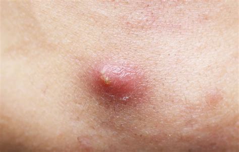 What Skin Cancer Looks Like A Pimple Skin Cancer Warning Arcadia