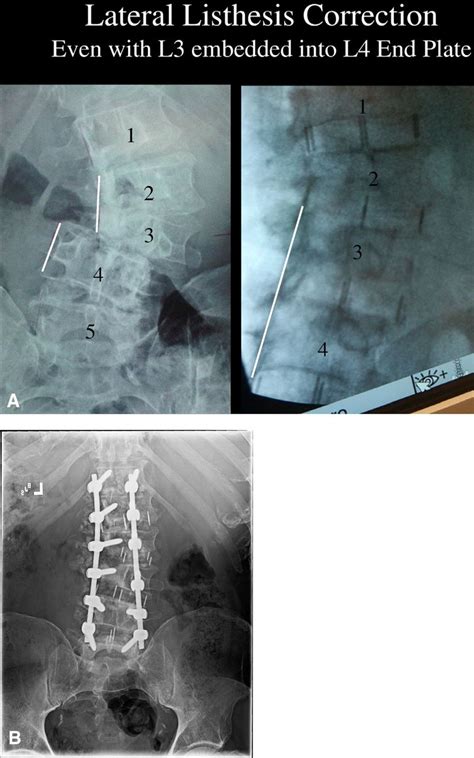 Multilevel Extreme Lateral Interbody Fusion Xlif And Osteotomies For