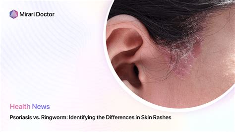Psoriasis Vs Ringworm Identifying The Differences In Skin Rashes