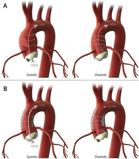 Complications And Failure Modes In The Proximal Thoracic Aorta