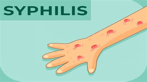 Syphilis Causes Symptoms Diagnosis And Treatment