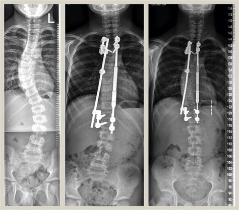 Example Of A Patient With An Early Onset Idiopathic Scoliosis Treated