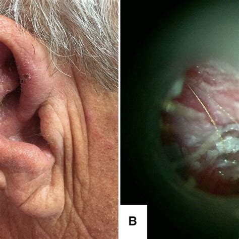 Herpes Zoster Oticus Hzot Involving Cranial Nerves Cns Vii And