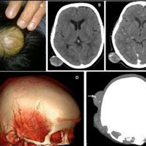 52 Years Female Presented With A Larger Right Parietal Scalp For Last 8