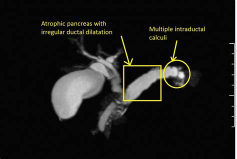 Hereditary Pancreatitis Other Imaging Findings Wikidoc