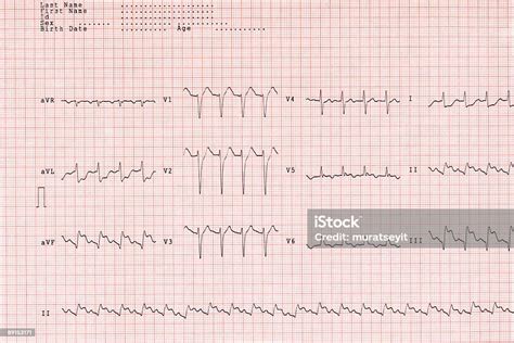 Different Ecg Waves Of A Myocardial Infarct Xl Stock Photo Download