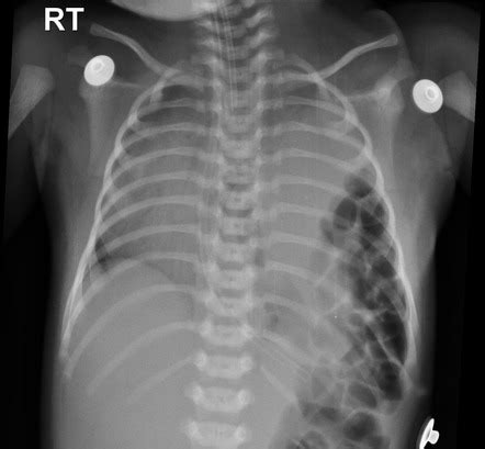 Bochdalek Hernia Radiology Reference Article Radiopaedia Org