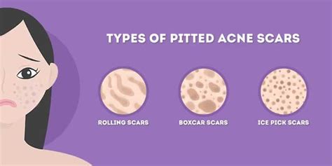 Best Ordinary Products For Pitted Acne Scars Touch Blogsphere