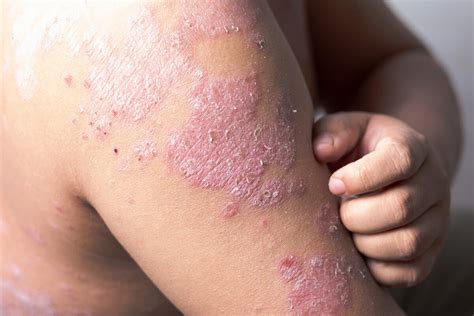 Psoriasis Symptoms Causes And Treatment Us News