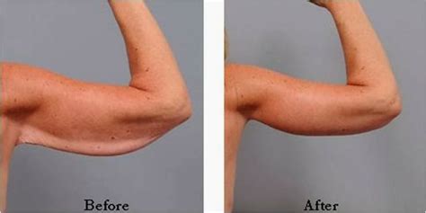 Upper Arm Plastic Surgery Before And After Before And After