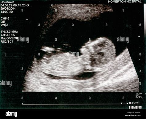 Ultrasonic Scan Of Twelve Week Baby Fetus Antenatal Scan Stock Photo