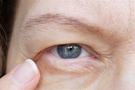 How To Fix Droopy Eyelids Dr Mark Doyle 2023
