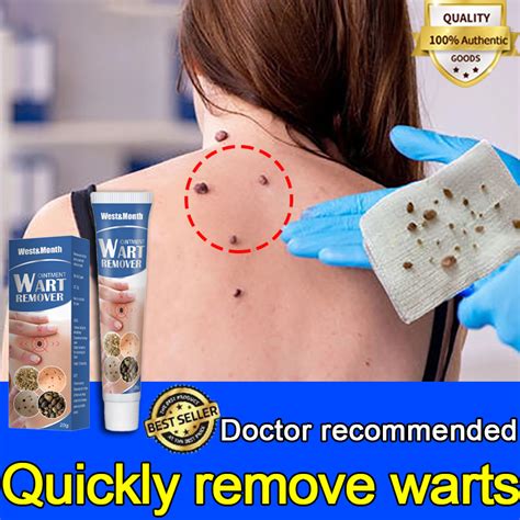 Warts Remover Original Cream Warts Magic Remover Warts Remover Skin