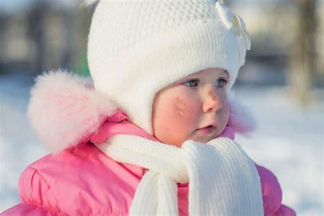 What Should I Do If My Child Has Frostbite Heres How To Treat It