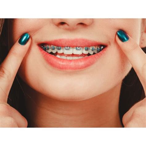 Radiant Red And Blue Braces Unleashing The Power Of Your Confident