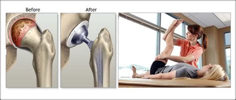 Total Hip Replacement Recovery Basics You Should Know Hip Replacement