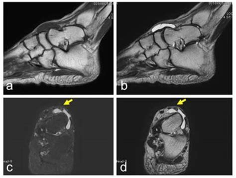 Persistent Symptoms Of Ganglion Cysts In The Dorsal Foot