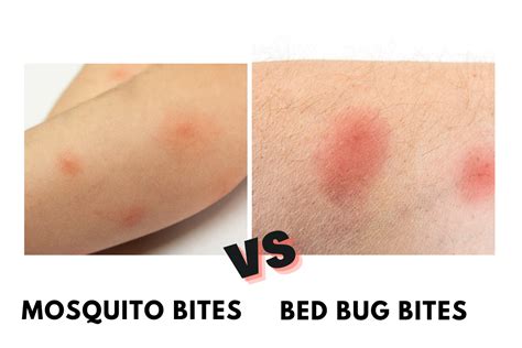 Bed Bug Bite Vs Mosquito Bite Pestqueen