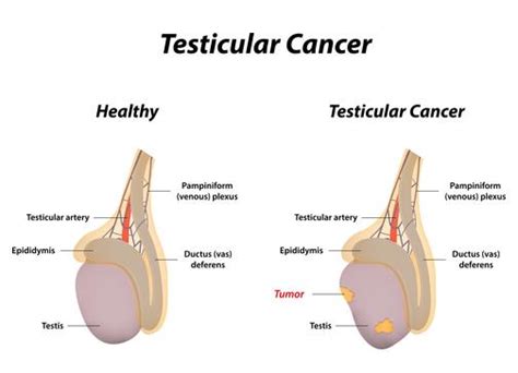 Testicular Cancer Symptoms Causes And Treatments Medical News Today