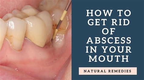 How To Get Rid Of Abscess In Your Mouth Natural Remedies Youtube