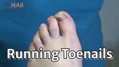 Do Runners Toenails Fall Off Running Nails Throwback Youtube