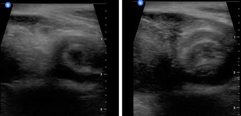 Ultrasonographic ‘whirlpool Sign’ In Testicular Torsion Bmj Case Reports