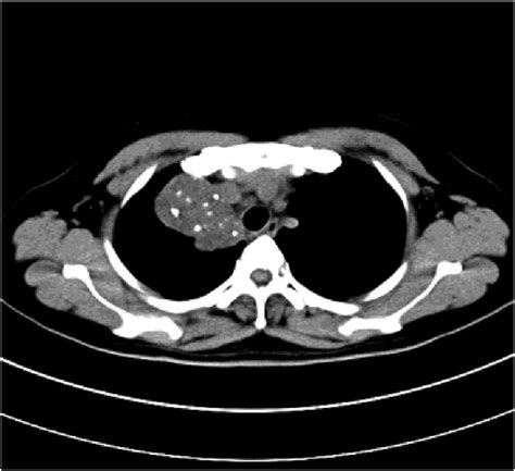 Pre Surgery Plain Ct Chest Showing A Necrotic Mass Calcification With