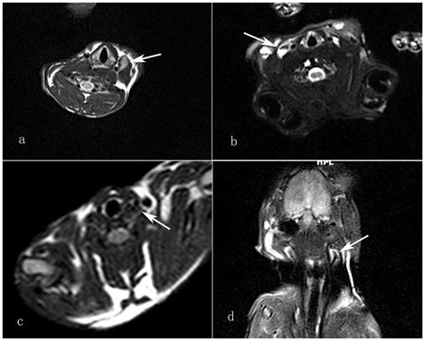 T2 Weighted Image Of The Neck Shows A Metastatic Lymph Node With