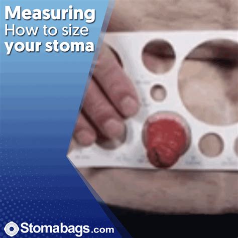 Measuring Your Stoma Size With Stomabags