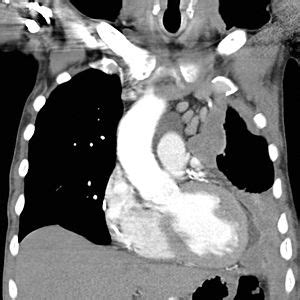 We did not find results for: Mesothelioma - Wikipedia