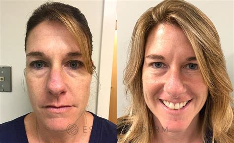 Botox® Cosmetic Before And After Pictures Case 7 Natick Ma