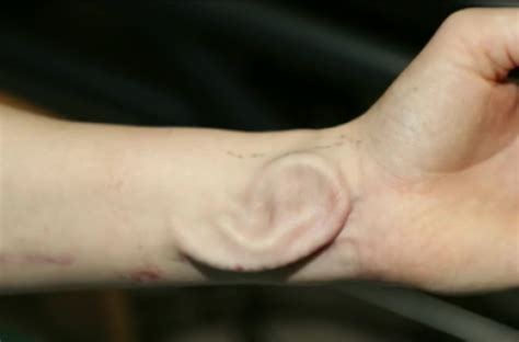 A Cultured Ear Transplant On The Forearm Of A Patient Ace Mind