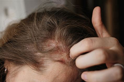 Wellnesscrown Net A Comprehensive Guide On Scalp Psoriasis