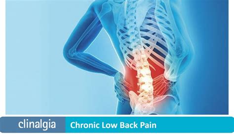Chronic Low Back Pain Origin And Treatment Clinalgia