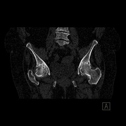 Osteoarthritis Of The Hip Grading Radiology Reference Article