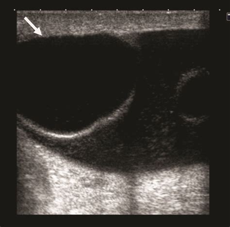 Hematocele Ultrasound