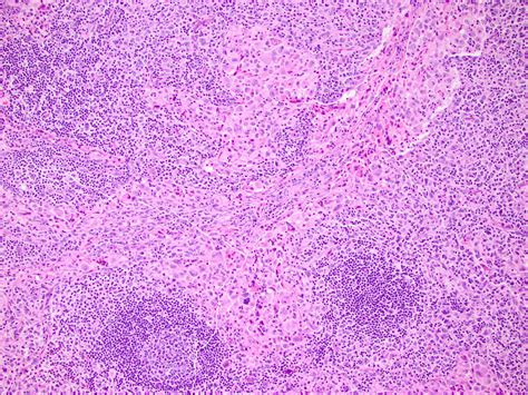 Pathology Outlines Histiocytic Sarcoma