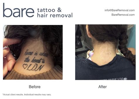 Before And After · Bareremoval