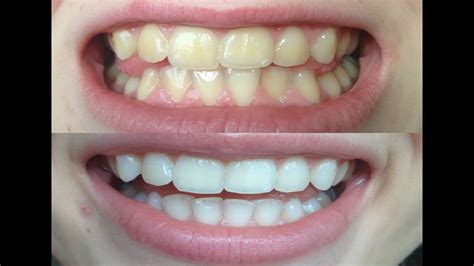 How I Whitened My Very Yellow Teeth Works Before And After Youtube