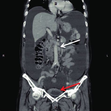 Colon Tumor In Size 3 Cm Over Sigmoid Colon Download Scientific Diagram