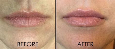 Juvederm Lips Before After Dr Monica Scheel Dermatology