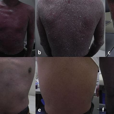 Photographs Of A Patient With Erythrodermic Psoriasis Treated With