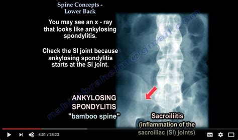 Spine Concepts Lower Back Ache Dnb Orthopaedics Ms Orthopedics Mrcs