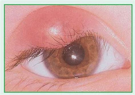 Eye Disorders Basicmedical Key