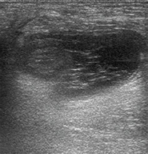 Preoperative Ultrasound Scan Of Right Groin Swelling Sh Open I