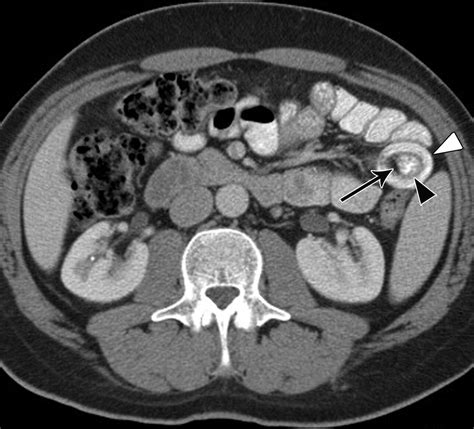 Adult Intestinal Intussusception Ct Appearances And Identification Of