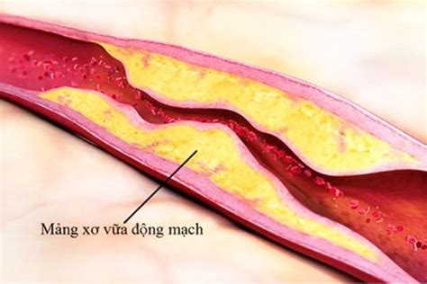 Atherosclerosis What You Need To Know Easy Healthy Every Day