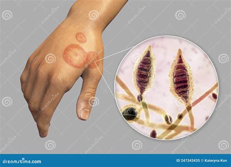 Fungal Infection On A Man S Hand Tinea Manuum And Close Up View Of